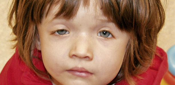 Bild zu Der diagnostische Blick - Ein 20 Monate altes Mädchen mit bilateralen Kalottendefekten