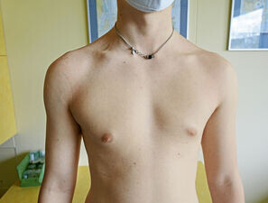 Bild zu Der diagnostische Blick - 17-Jähriger mit Abflachung der linken Thoraxmuskulatur