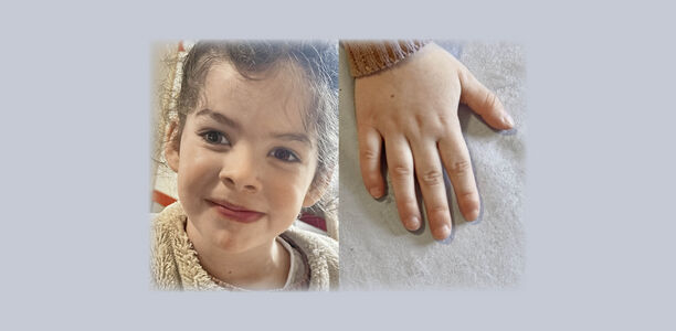 Bild zu Der diagnostische Blick - Ein 3-jähriges Mädchen mit Entwicklungsstörung, fazialen Auffälligkeiten und Klinobrachydaktylie