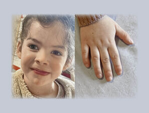 Bild zu Der diagnostische Blick - 3-Jährige mit Entwicklungsstörung, fazialen Auffälligkeiten und Klinobrachydaktylie