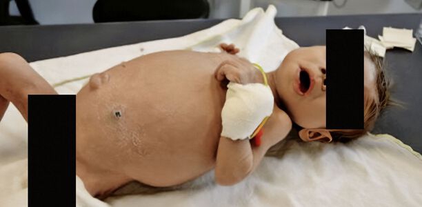 Bild zu Neonatale Cholestase  - Was in den ersten zwei Lebenswochen wichtig ist