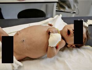 Bild zu Neonatale Cholestase  - Was in den ersten zwei Lebenswochen wichtig ist